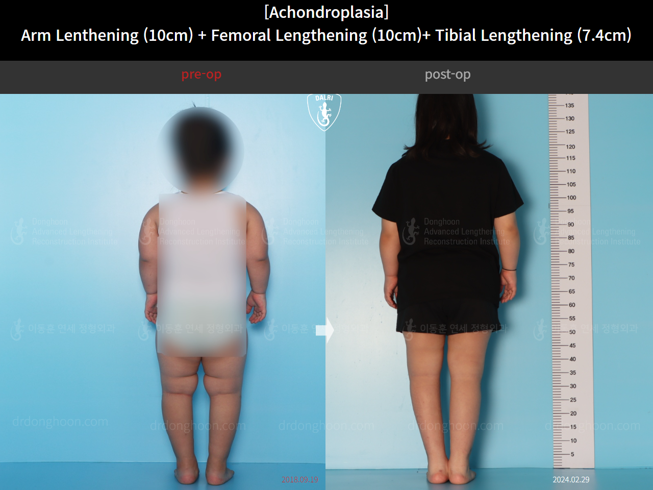 Before and after paediatric congenital condition, case 18310546, image 4, Dr. Donghoon institute (DALRI)