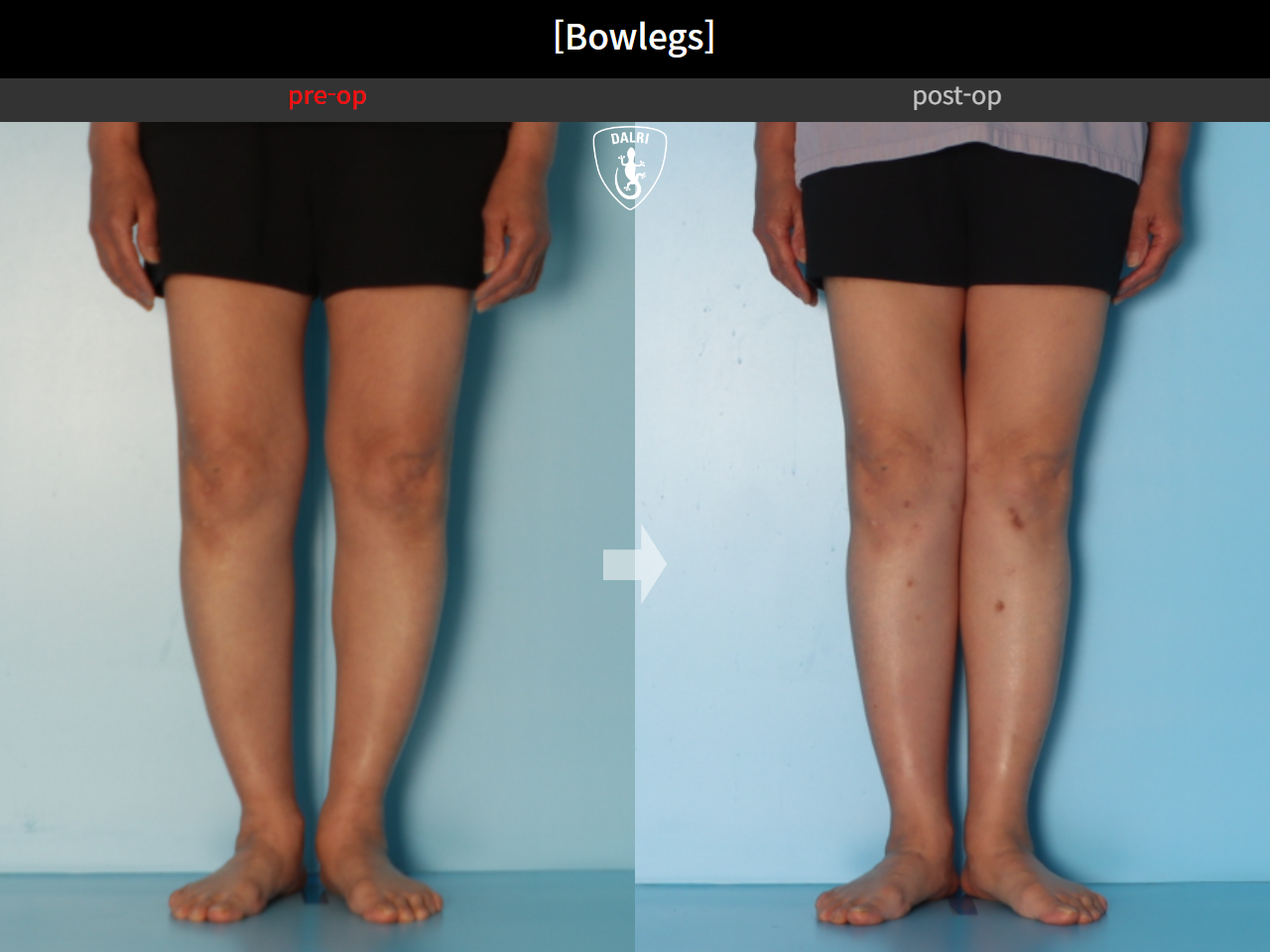Before and after adult bowlegs, case 30770070, image 10, Dr. Donghoon institute (DALRI)