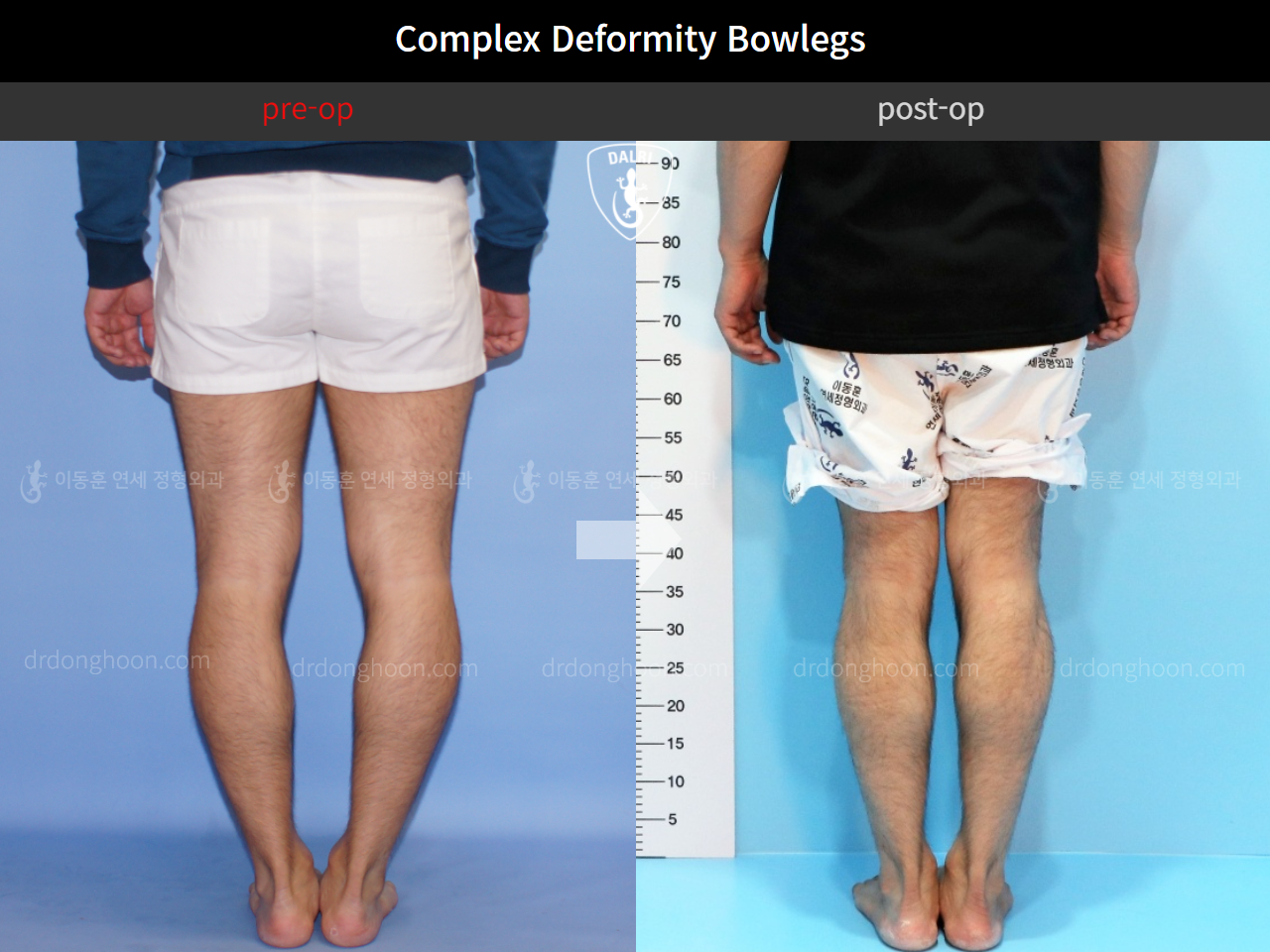 Before and after adult bowlegs, case 4311059, image 4, Dr. Donghoon institute (DALRI)
