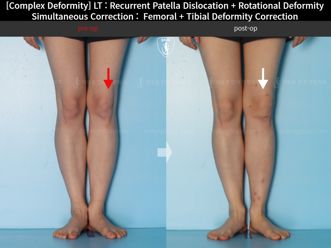 Before and after recurrent patella dislocation, case 18088207, image 3, Dr. Donghoon institute (DALRI)