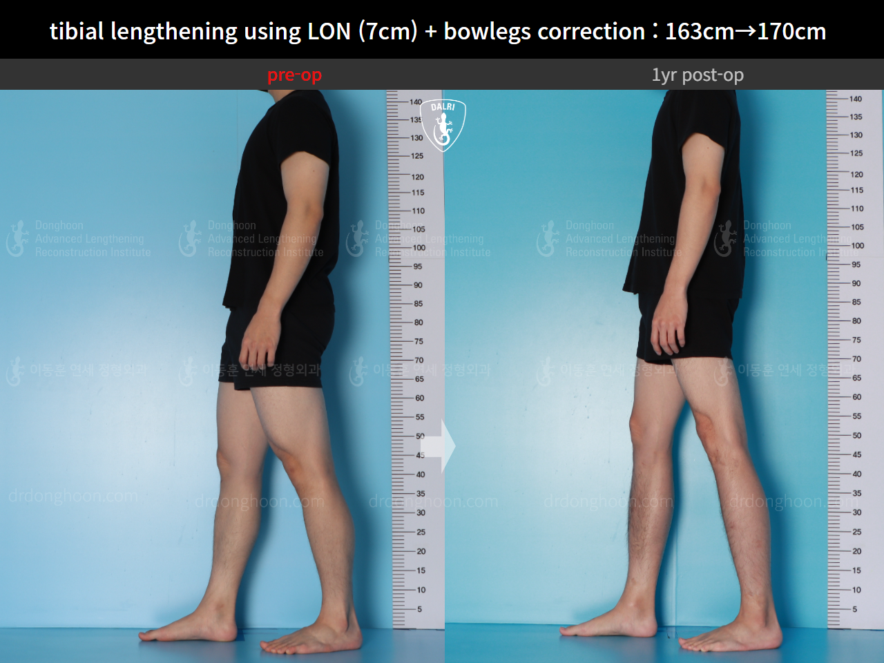 Before and after cll + deformity correction, case 16131910, image 6, Dr. Donghoon institute (DALRI)