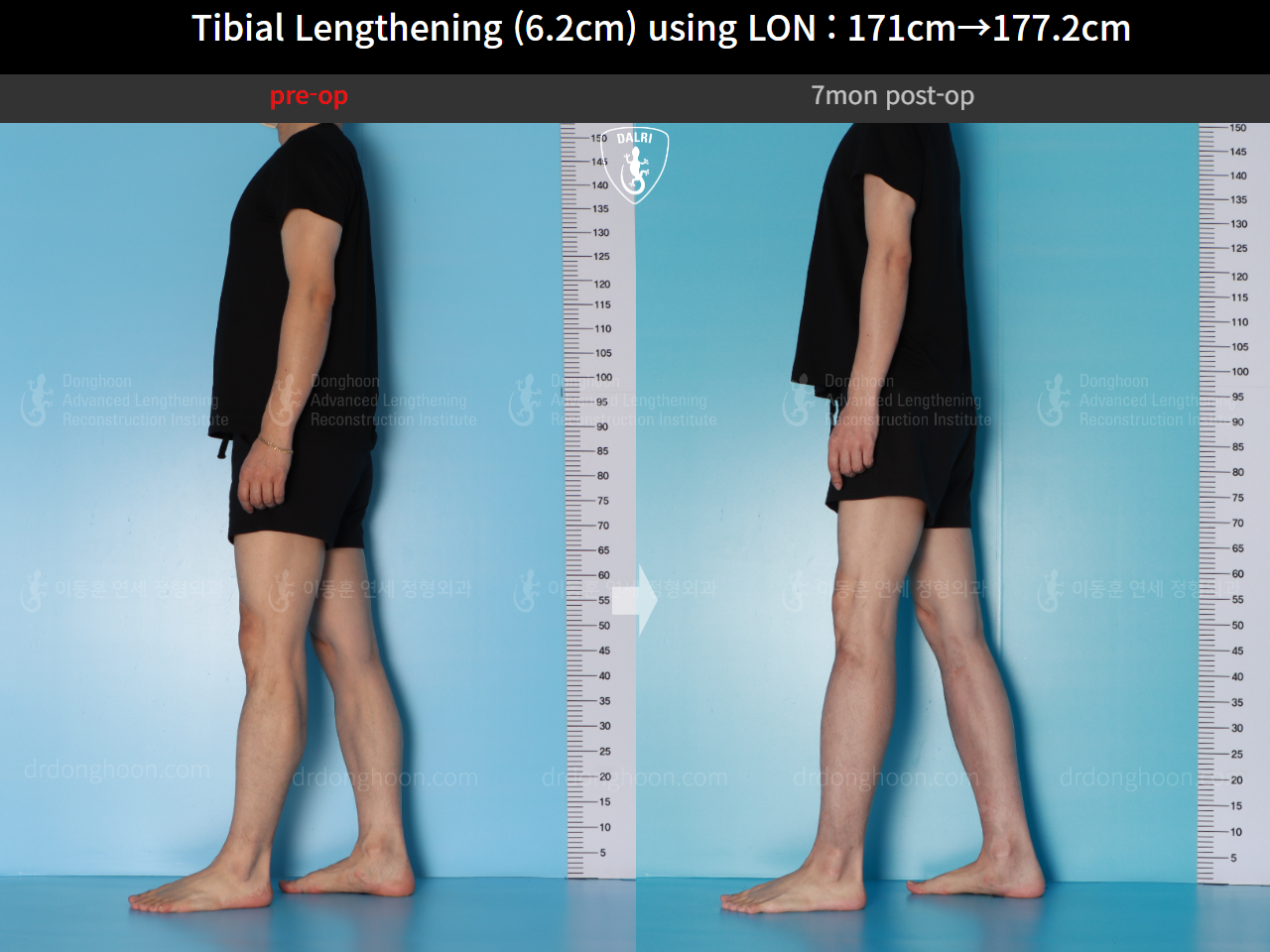 Before and after cll lon, case 16713373, image 6, Dr. Donghoon institute (DALRI)