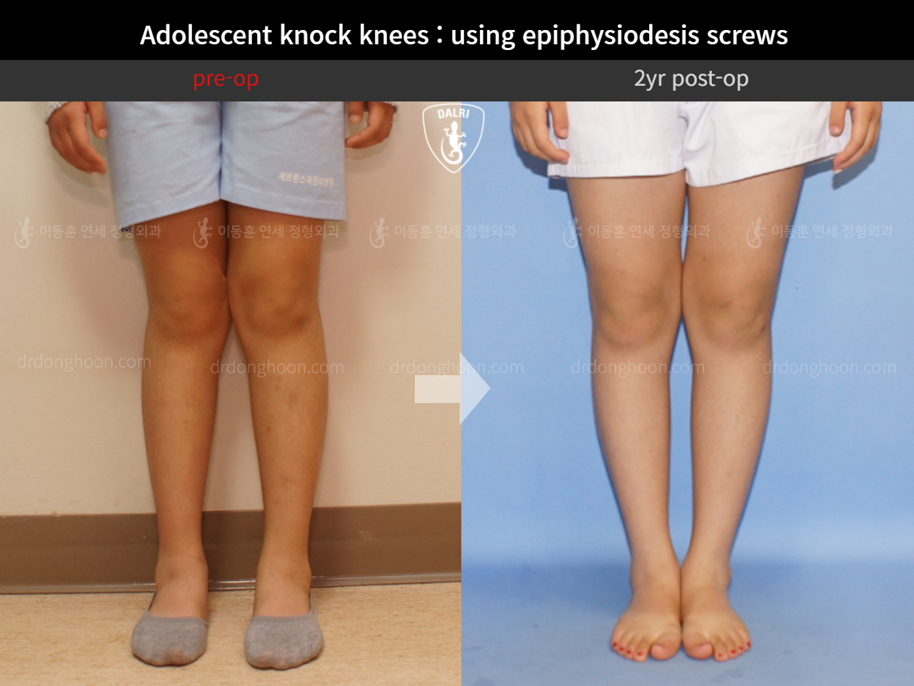 Before and after paediatric & adolescent knock knees, case 4640518, image 5, Dr. Donghoon institute (DALRI)