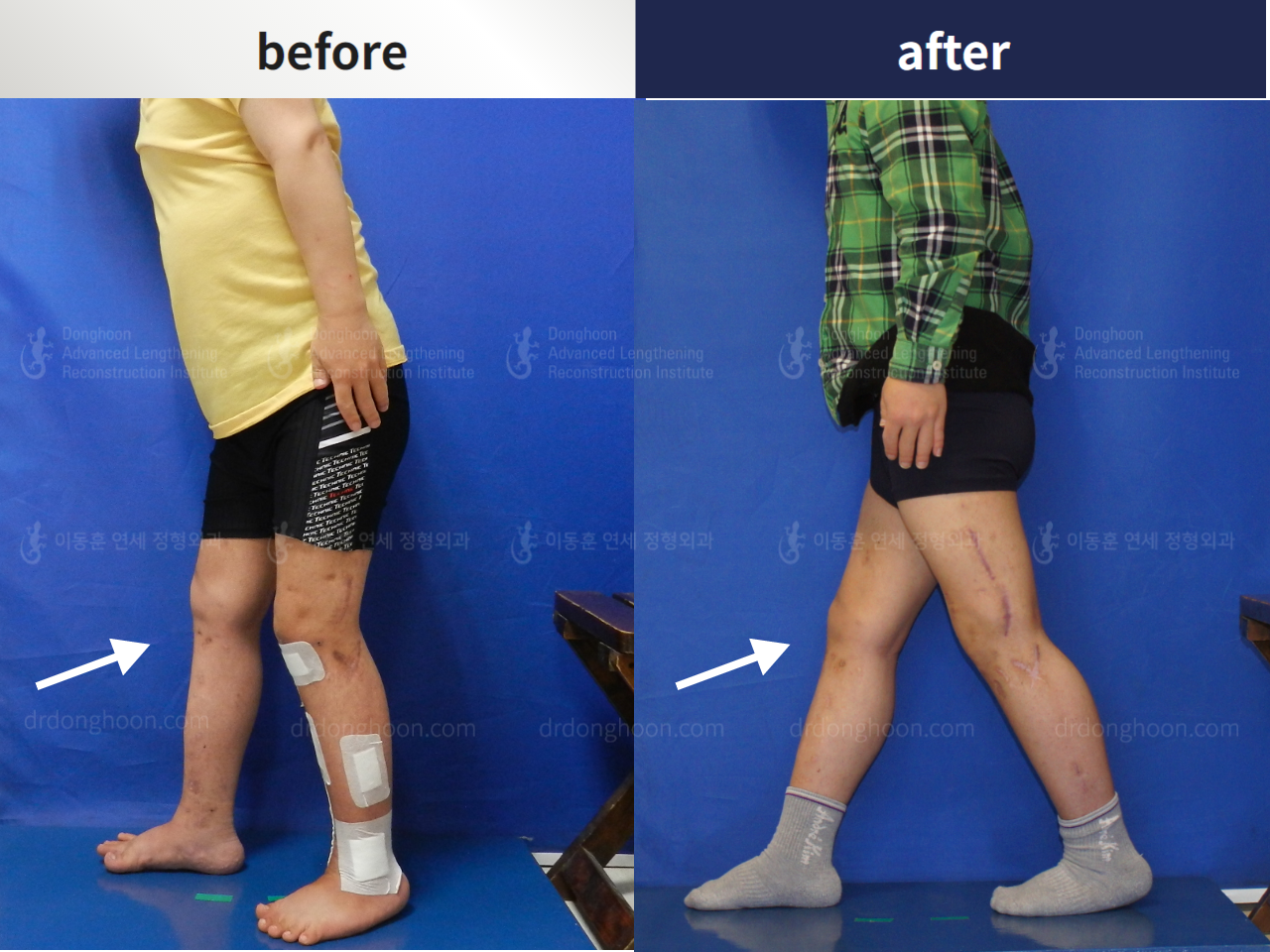 Before and after flexion deformity, case 4360862, image 1, Dr. Donghoon institute (DALRI)