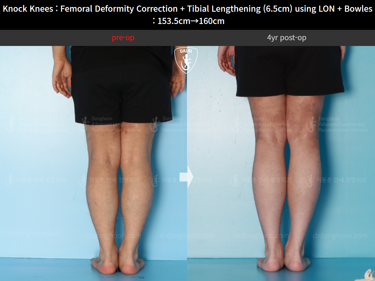 Before and after cll + deformity correction, case 16723810, image 6, Dr. Donghoon institute (DALRI)