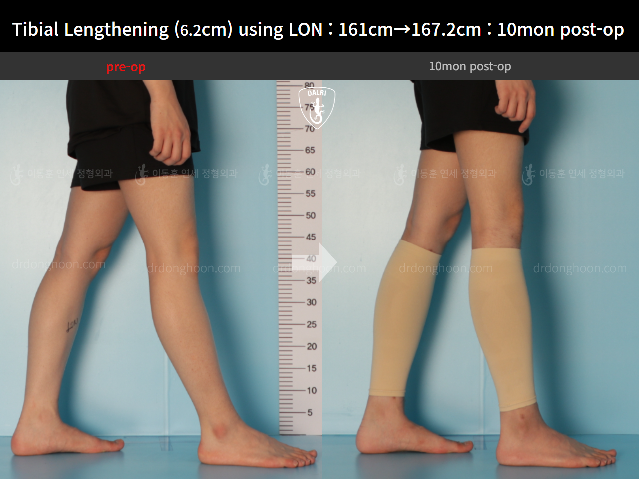 Before and after cll lon, case 14502141, image 7, Dr. Donghoon institute (DALRI)
