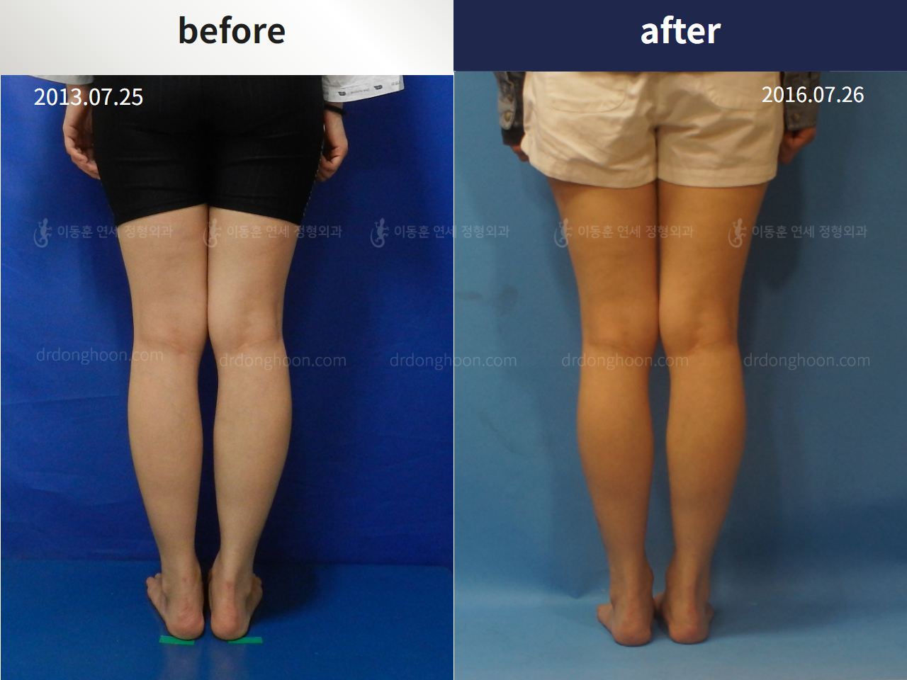 Before and after complex deformity, case 4251596, image 1, Dr. Donghoon institute (DALRI)