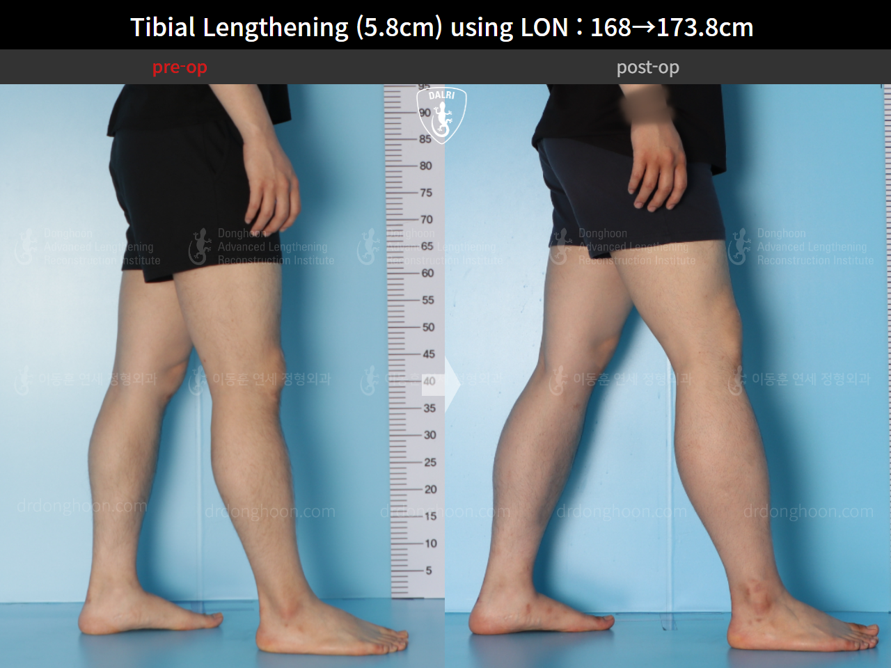 Before and after cll lon, case 15625788, image 7, Dr. Donghoon institute (DALRI)