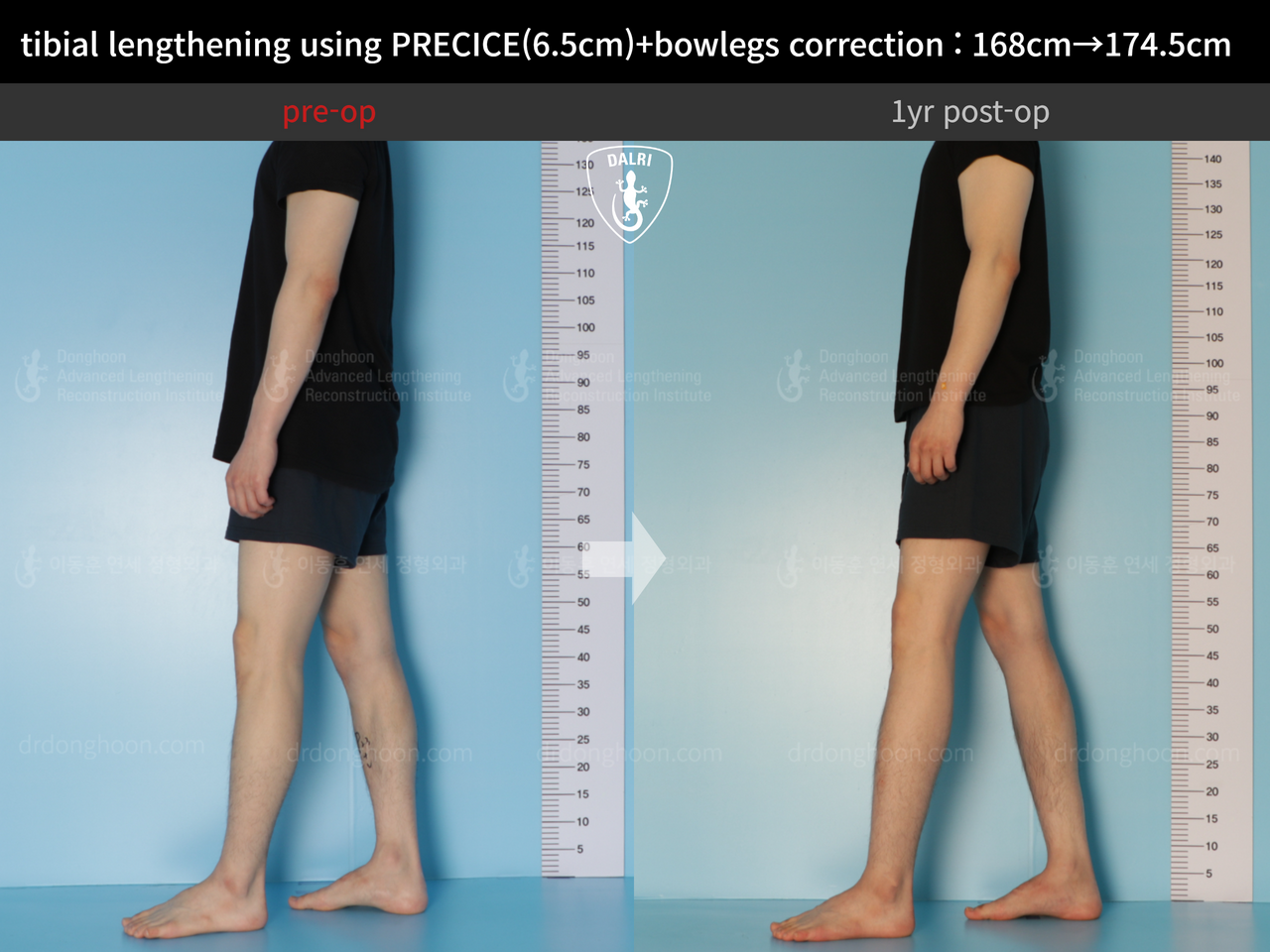 Before and after cll precice, case 12409993, image 4, Dr. Donghoon institute (DALRI)