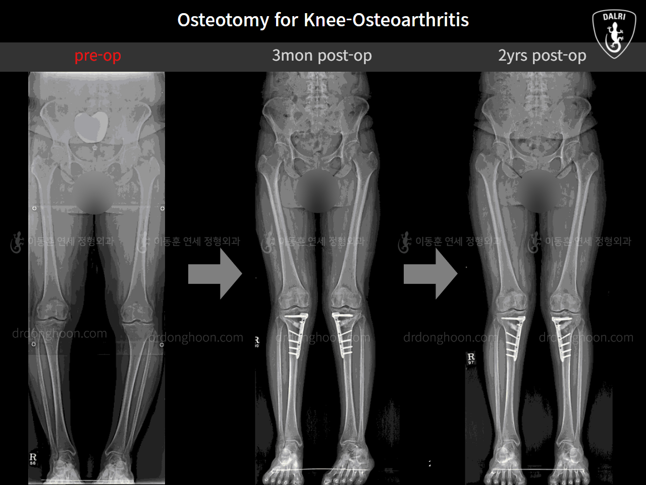 Before and after osteotomy for knee osteoarthritis, case 11785573, image 7, Dr. Donghoon institute (DALRI)
