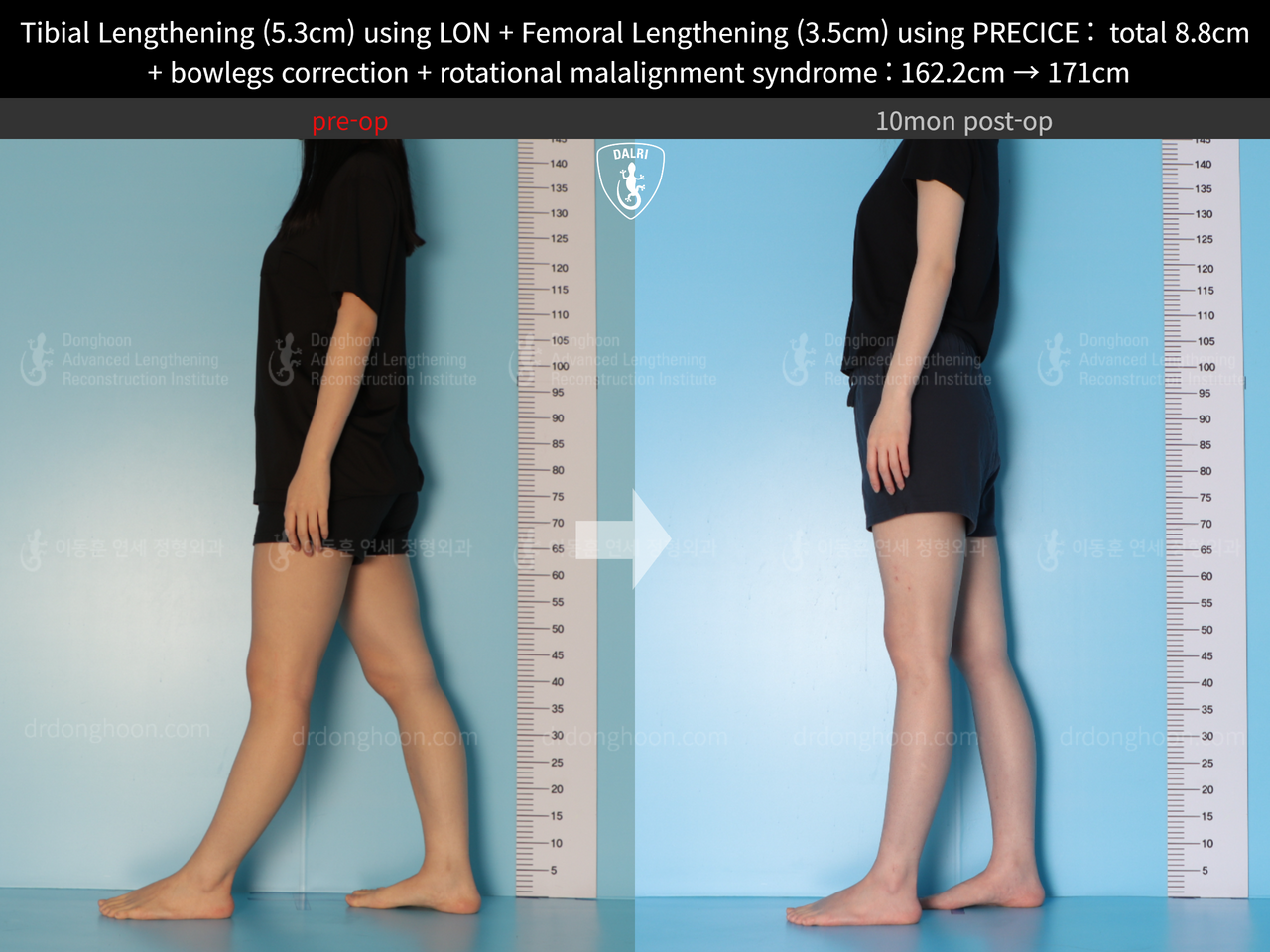 Before and after cll + deformity correction, case 13127167, image 8, Dr. Donghoon institute (DALRI)