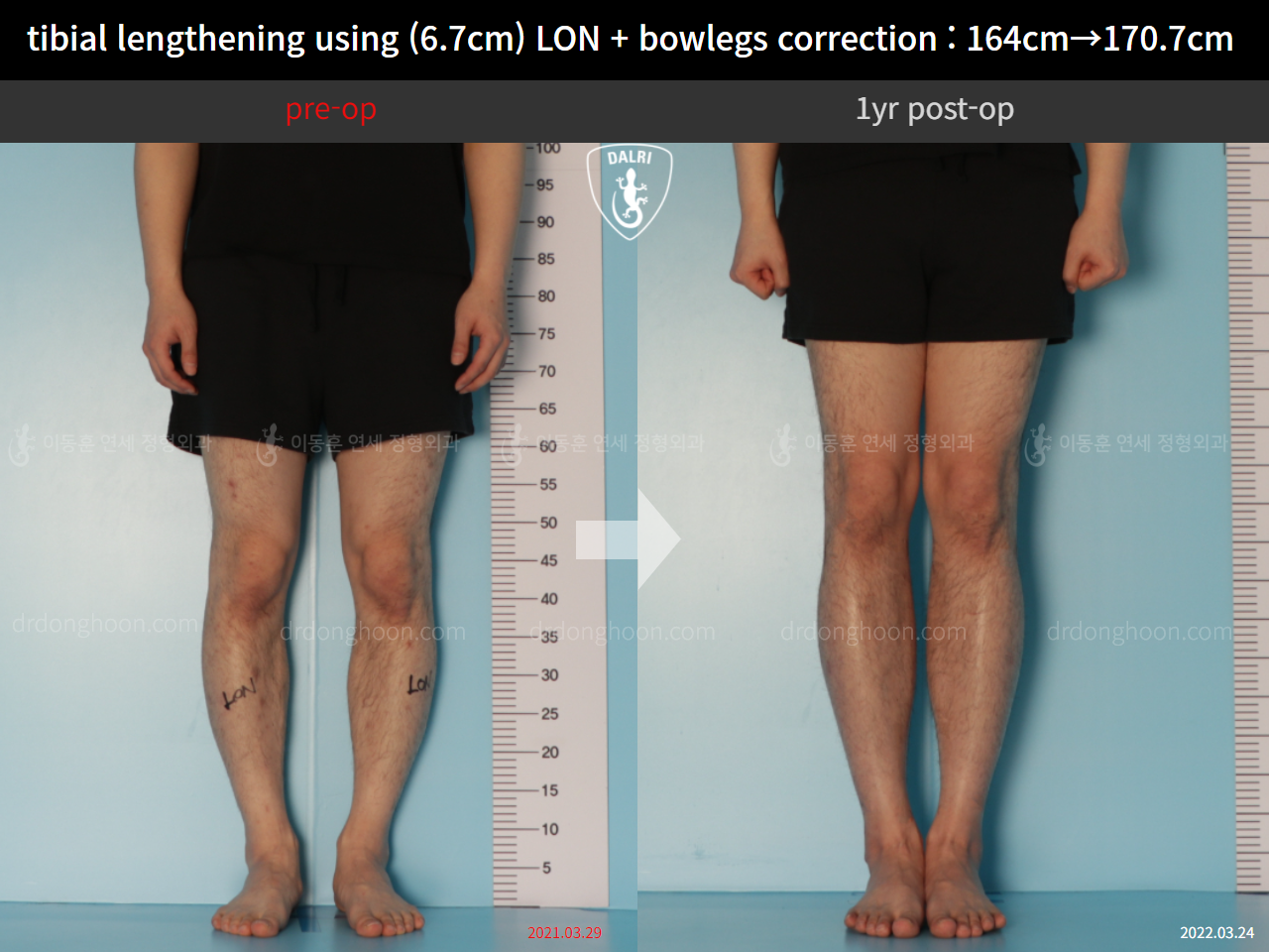 Before and after cll + deformity correction, case 11037343, image 5, Dr. Donghoon institute (DALRI)