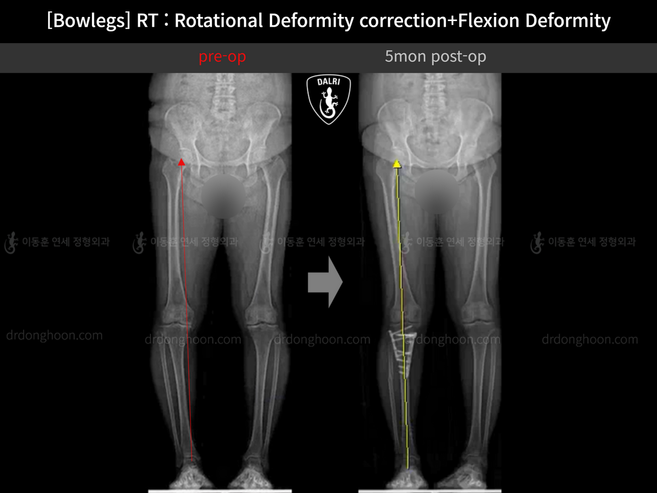 Before and after adult bowlegs, case 13668670, image 9, Dr. Donghoon institute (DALRI)