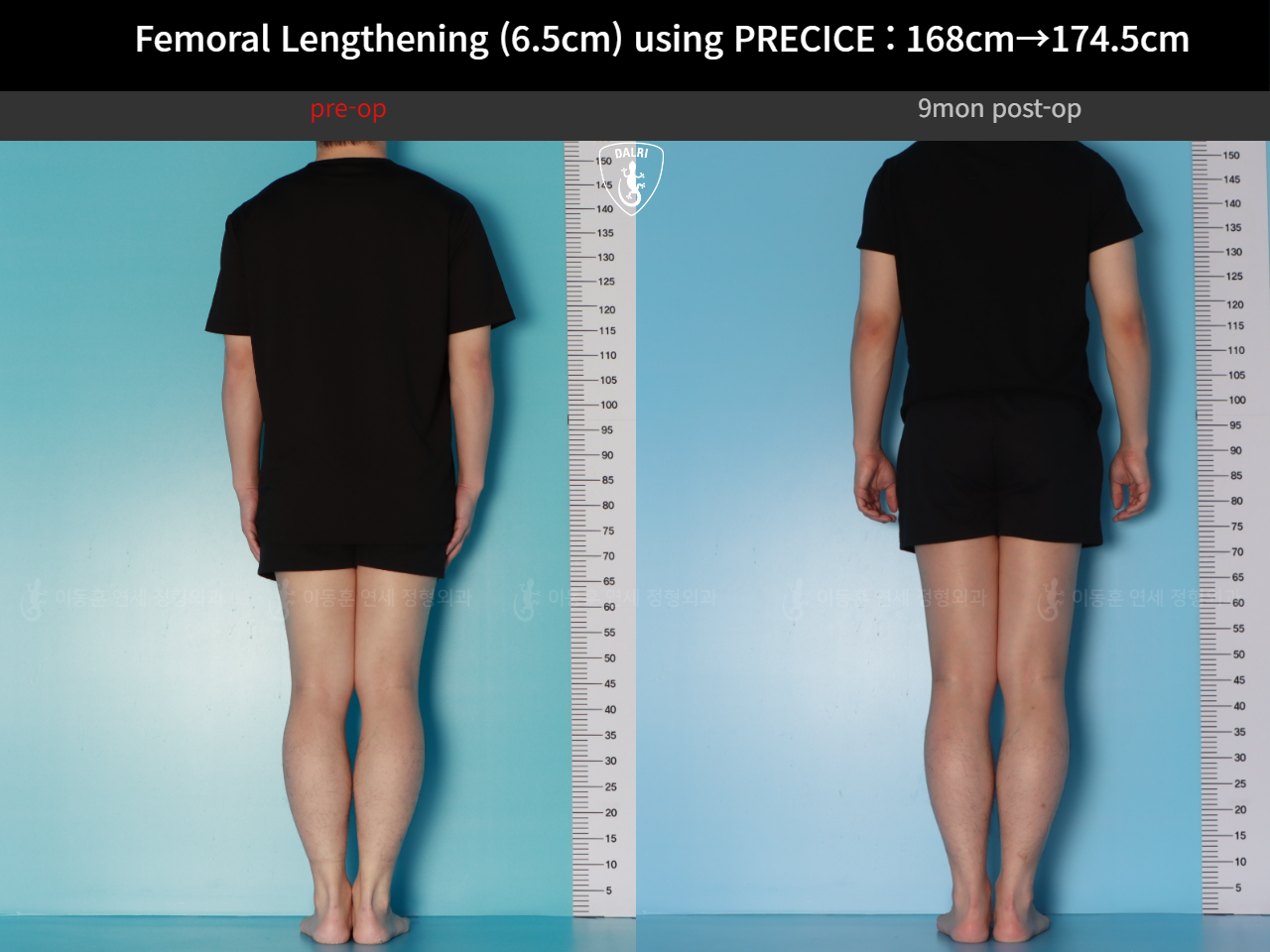 Before and after cll precice, case 123911358, image 2, Dr. Donghoon institute (DALRI)