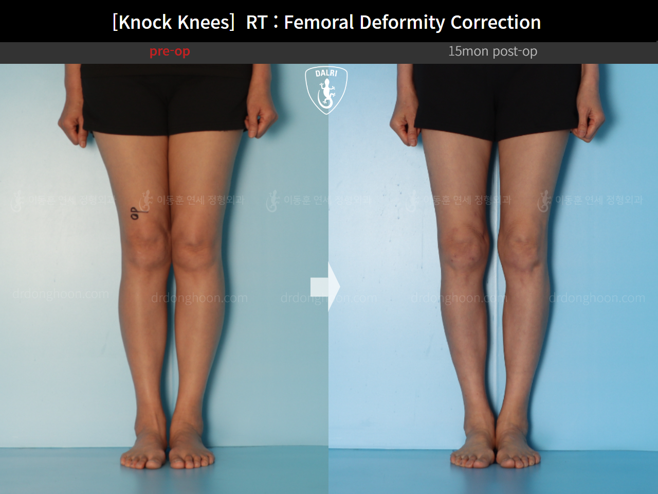 Before and after adult knock knees, case 14462642, image 7, Dr. Donghoon institute (DALRI)