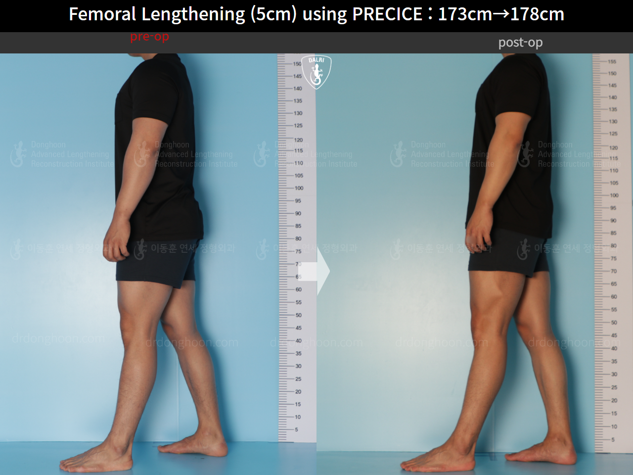 Before and after cll precice, case 21702609, image 6, Dr. Donghoon institute (DALRI)