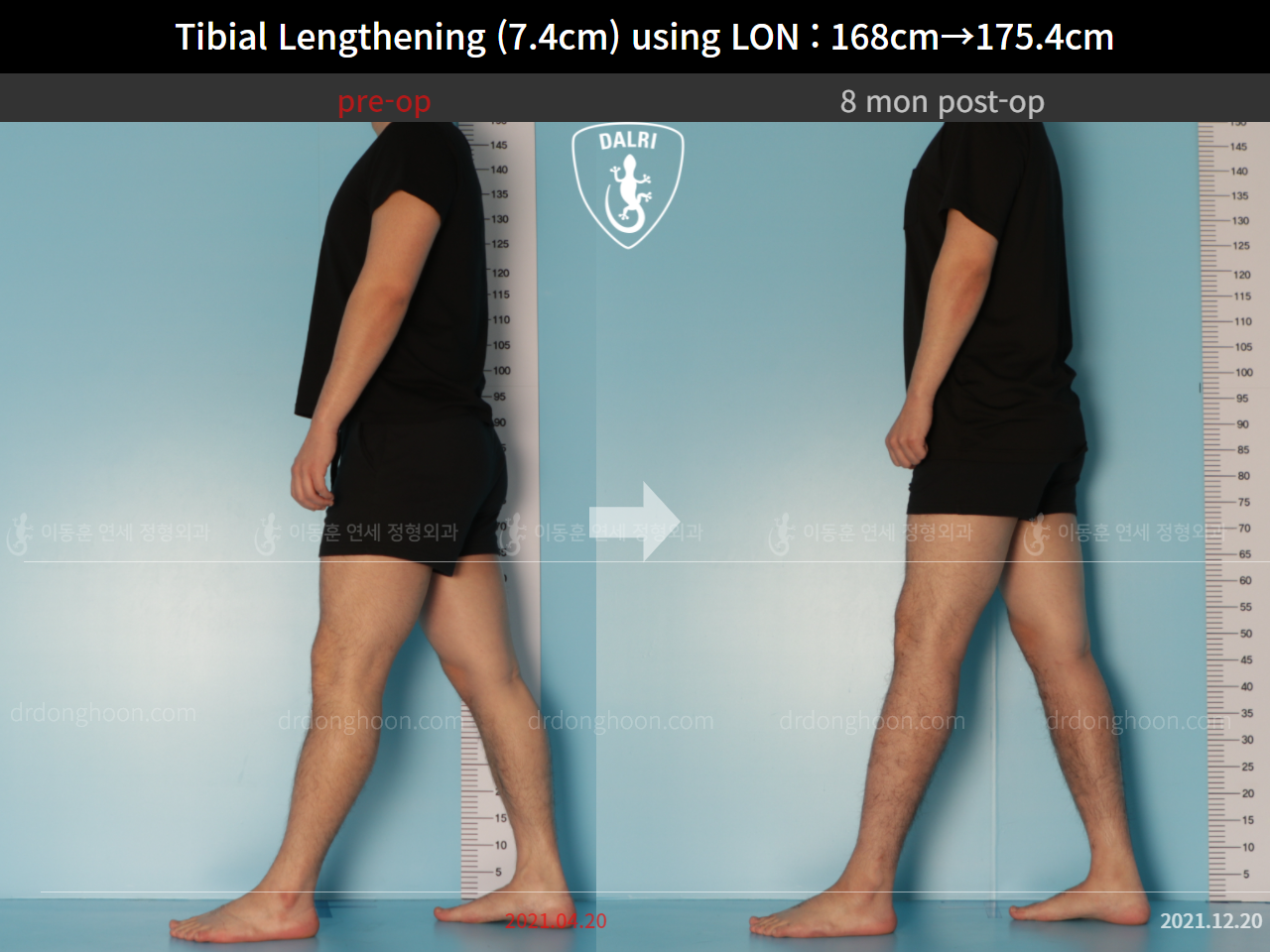 Before and after cll lon, case 9188051, image 3, Dr. Donghoon institute (DALRI)