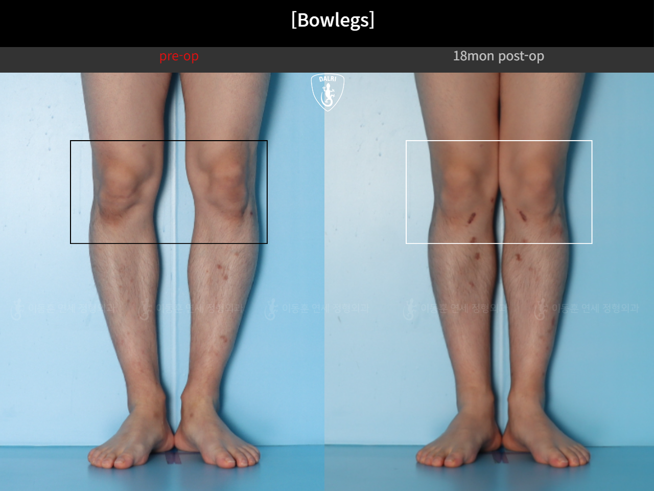Before and after adult bowlegs, case 124254182, image 7, Dr. Donghoon institute (DALRI)