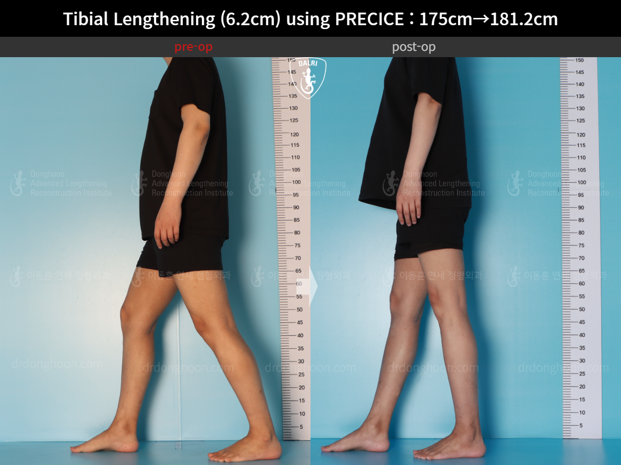 Before and after cll precice, case 16277428, image 6, Dr. Donghoon institute (DALRI)