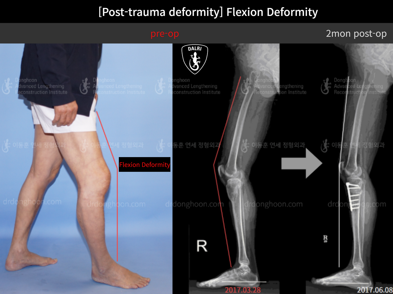 Before and after flexion deformity, case 12588835, image 1, Dr. Donghoon institute (DALRI)