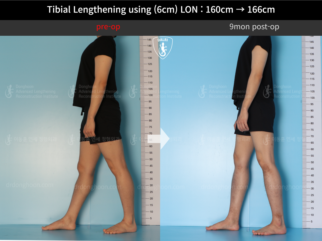 Before and after cll lon, case 13326359, image 6, Dr. Donghoon institute (DALRI)