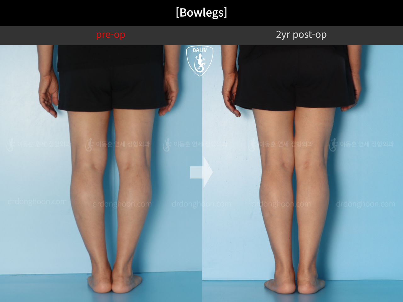 Before and after adult bowlegs, case 13250883, image 6, Dr. Donghoon institute (DALRI)