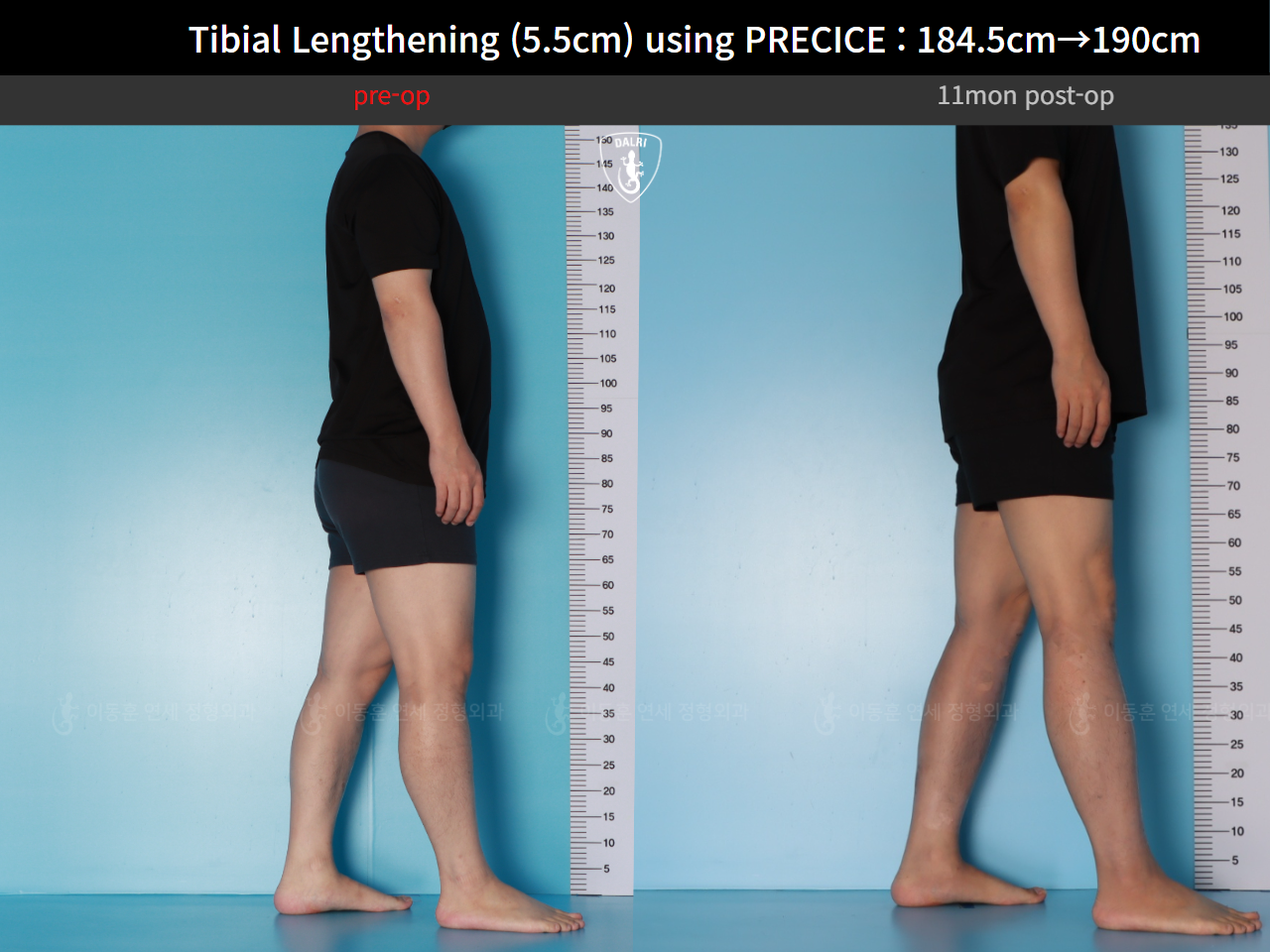 Before and after cll precice, case 125279355, image 5, Dr. Donghoon institute (DALRI)