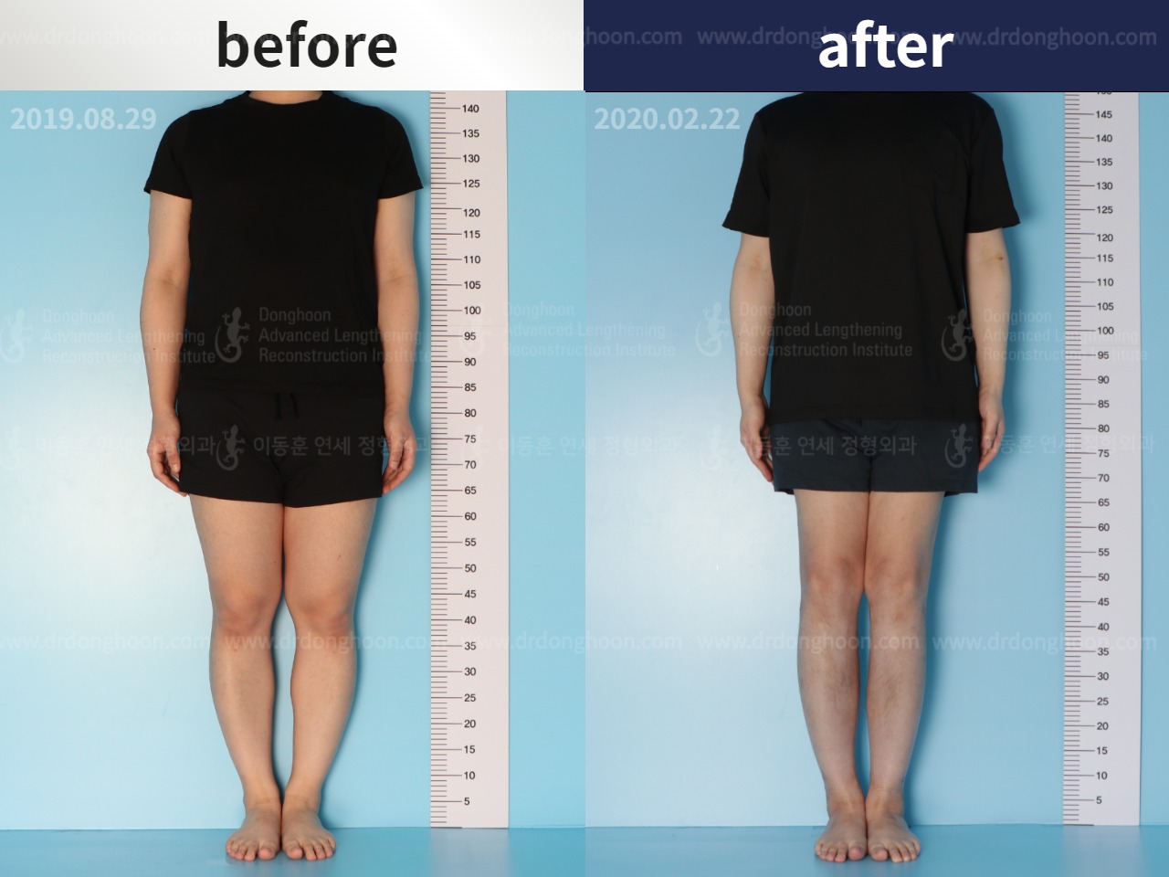 Before and after cll lon, case 4577808, image 1, Dr. Donghoon institute (DALRI)