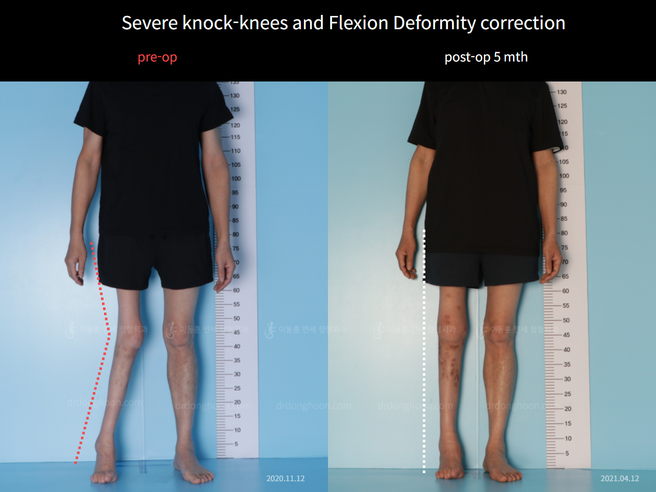 Before and after adult knock knees, case 6779059, image 2, Dr. Donghoon institute (DALRI)