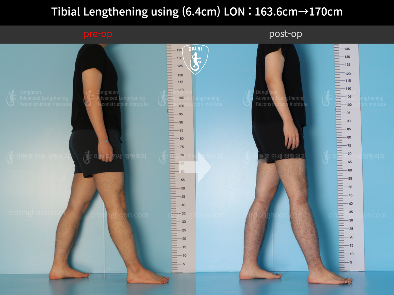 Before and after cll lon, case 12779092, image 3, Dr. Donghoon institute (DALRI)