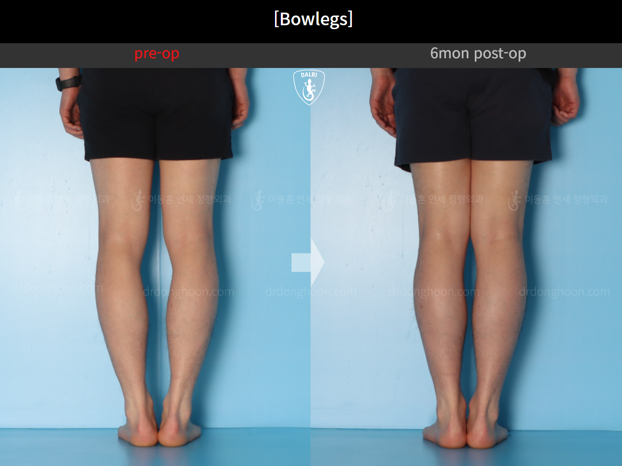 Before and after adult bowlegs, case 14742489, image 8, Dr. Donghoon institute (DALRI)