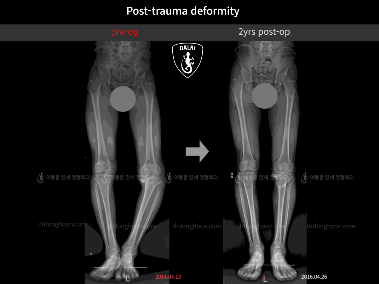 Before and after post-trauma deformity, case 8021097, image 3, Dr. Donghoon institute (DALRI)