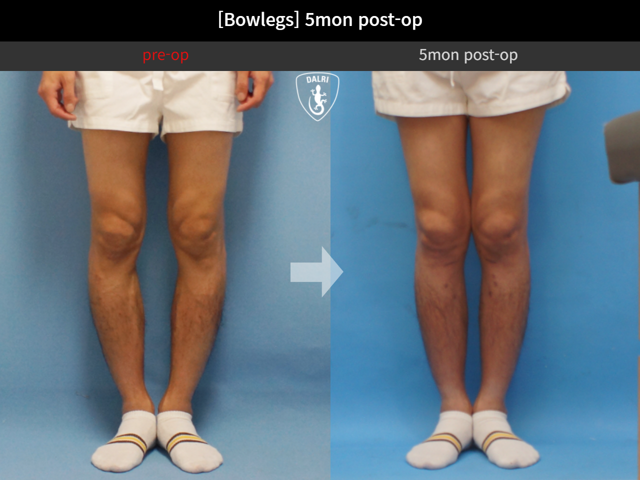 Before and after adult bowlegs, case 4311030, image 4, Dr. Donghoon institute (DALRI)