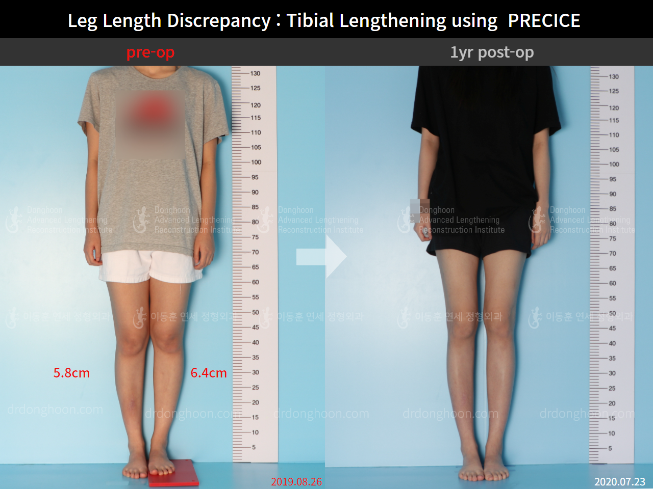 Before and after adult lld, case 8910234, image 1, Dr. Donghoon institute (DALRI)