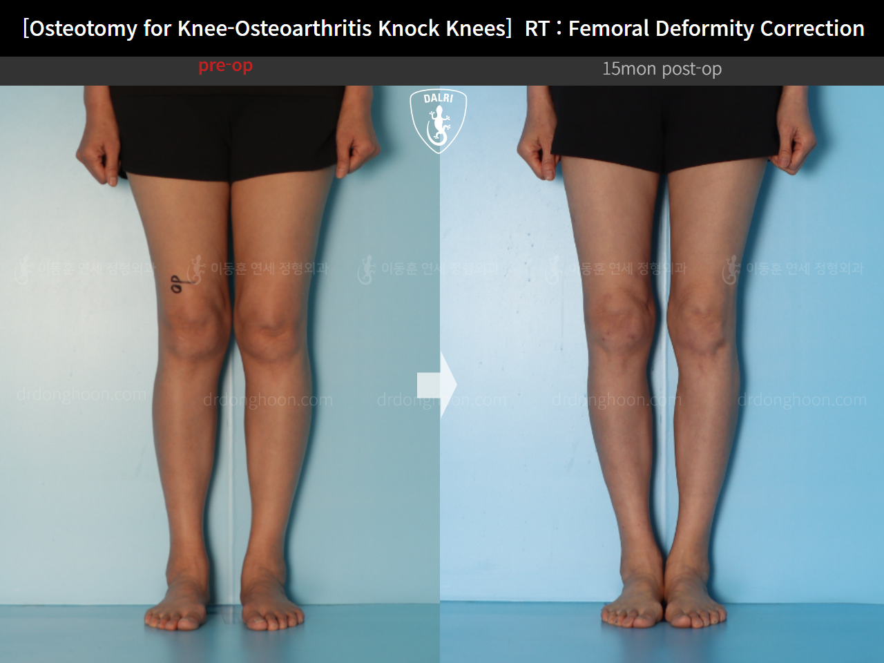 Before and after osteotomy for knee osteoarthritis, case 14462707, image 6, Dr. Donghoon institute (DALRI)