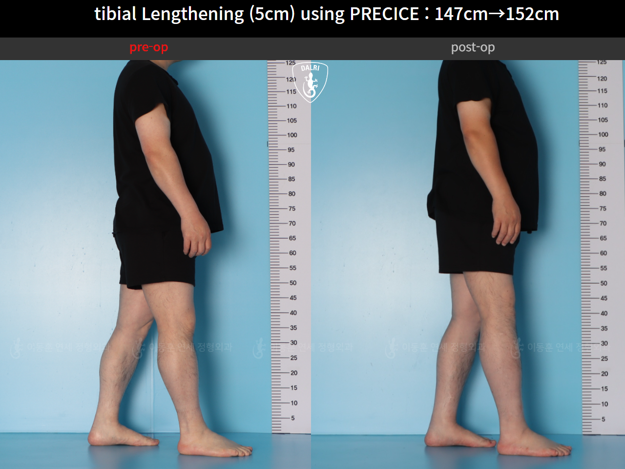 Before and after cll precice, case 89098588, image 5, Dr. Donghoon institute (DALRI)