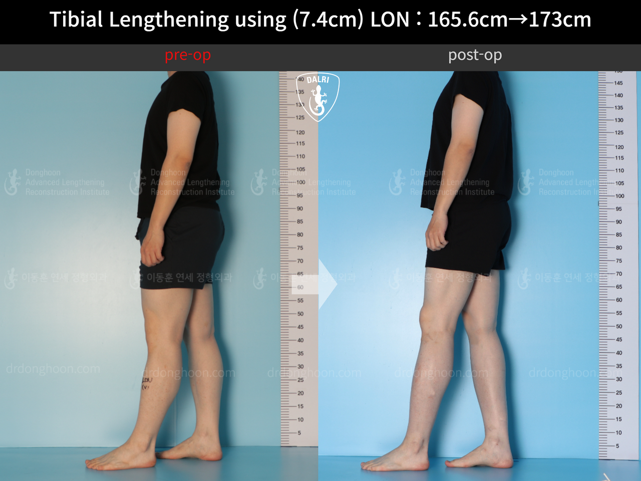 Before and after cll lon, case 13634644, image 3, Dr. Donghoon institute (DALRI)