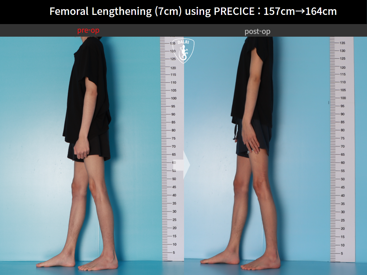 Before and after cll precice, case 31554406, image 4, Dr. Donghoon institute (DALRI)