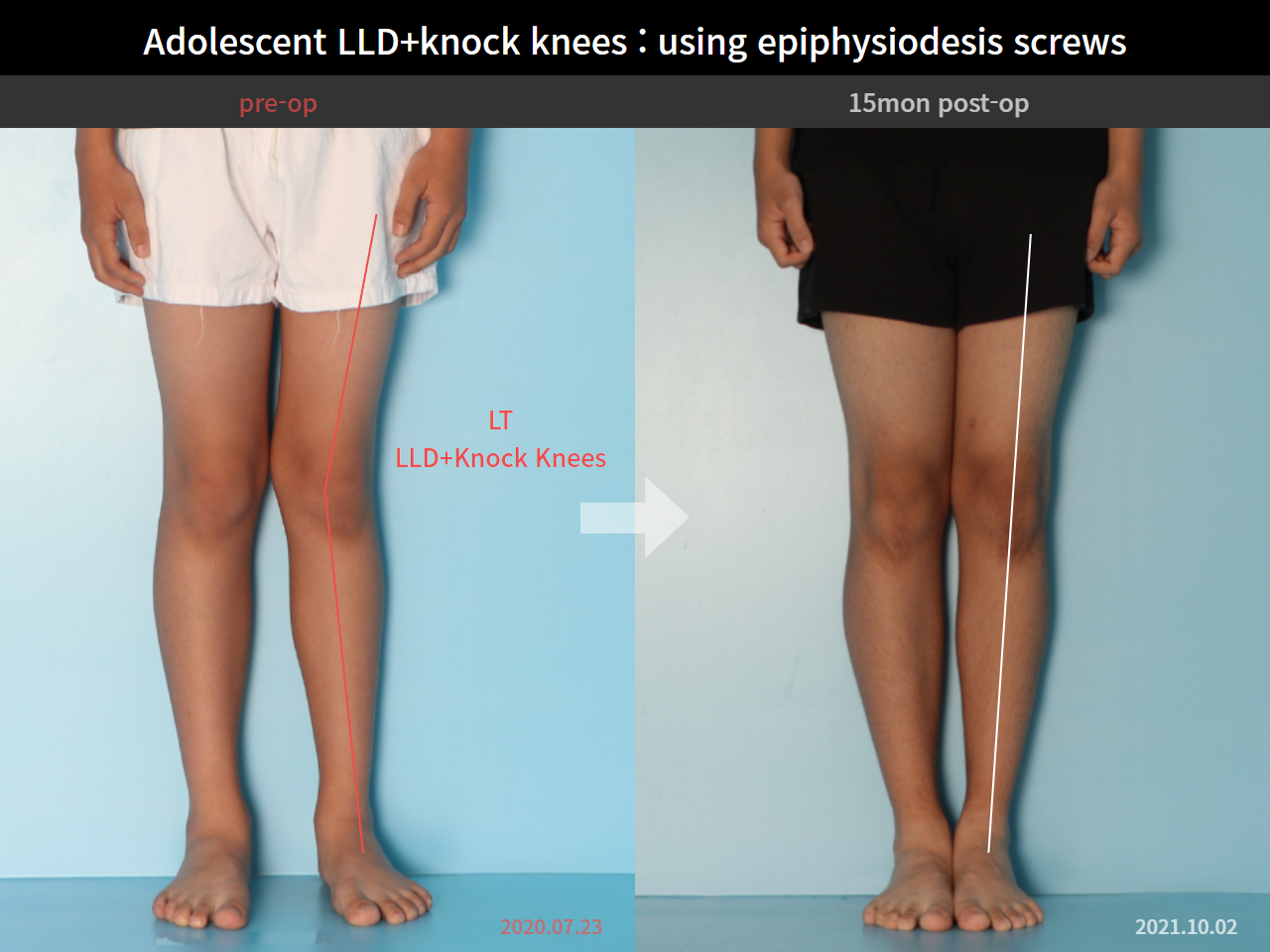 Before and after paediatric & adolescent knock knees, case 8413324, image 3, Dr. Donghoon institute (DALRI)