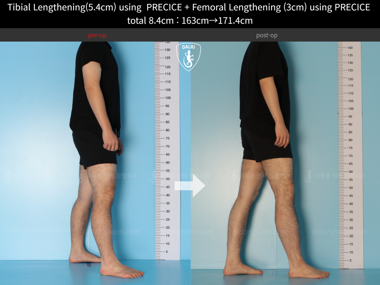 Before and after cll precice, case 12051302, image 6, Dr. Donghoon institute (DALRI)