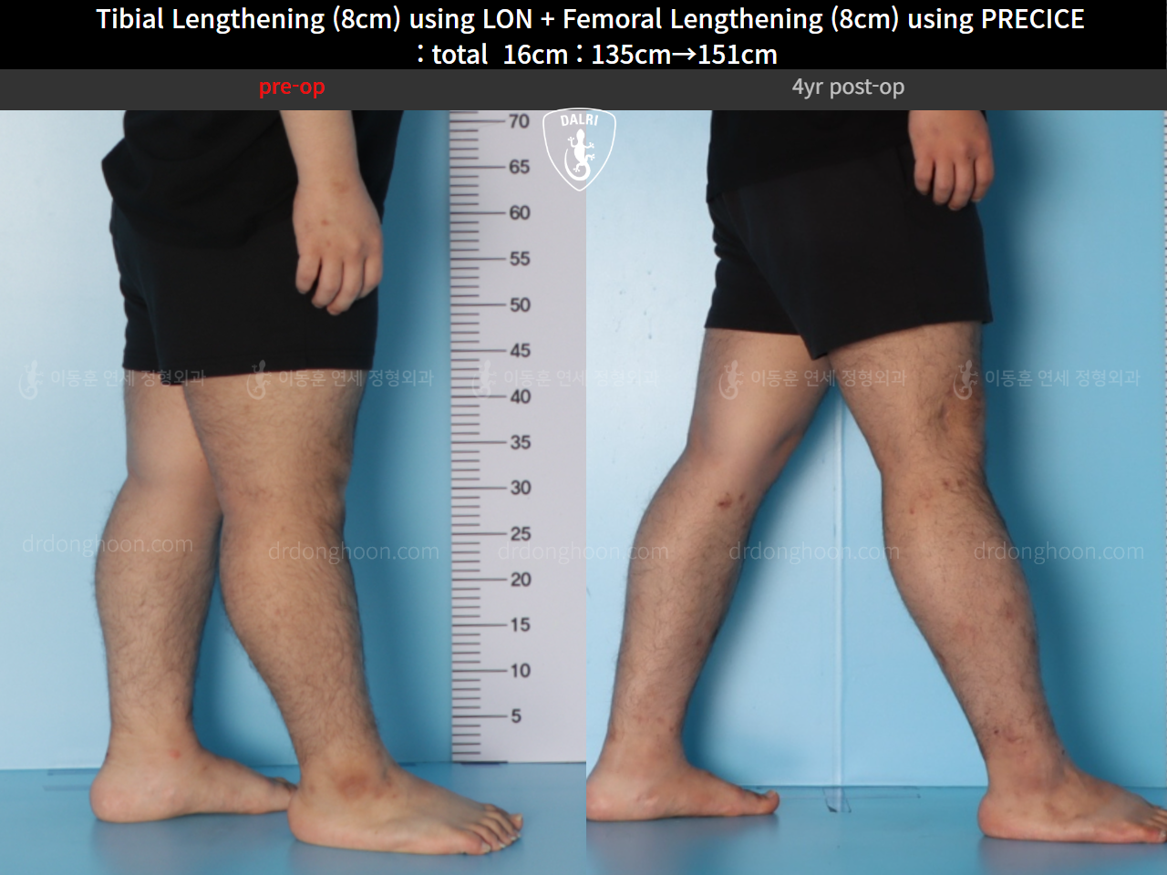 Before and after cll precice, case 128435842, image 9, Dr. Donghoon institute (DALRI)