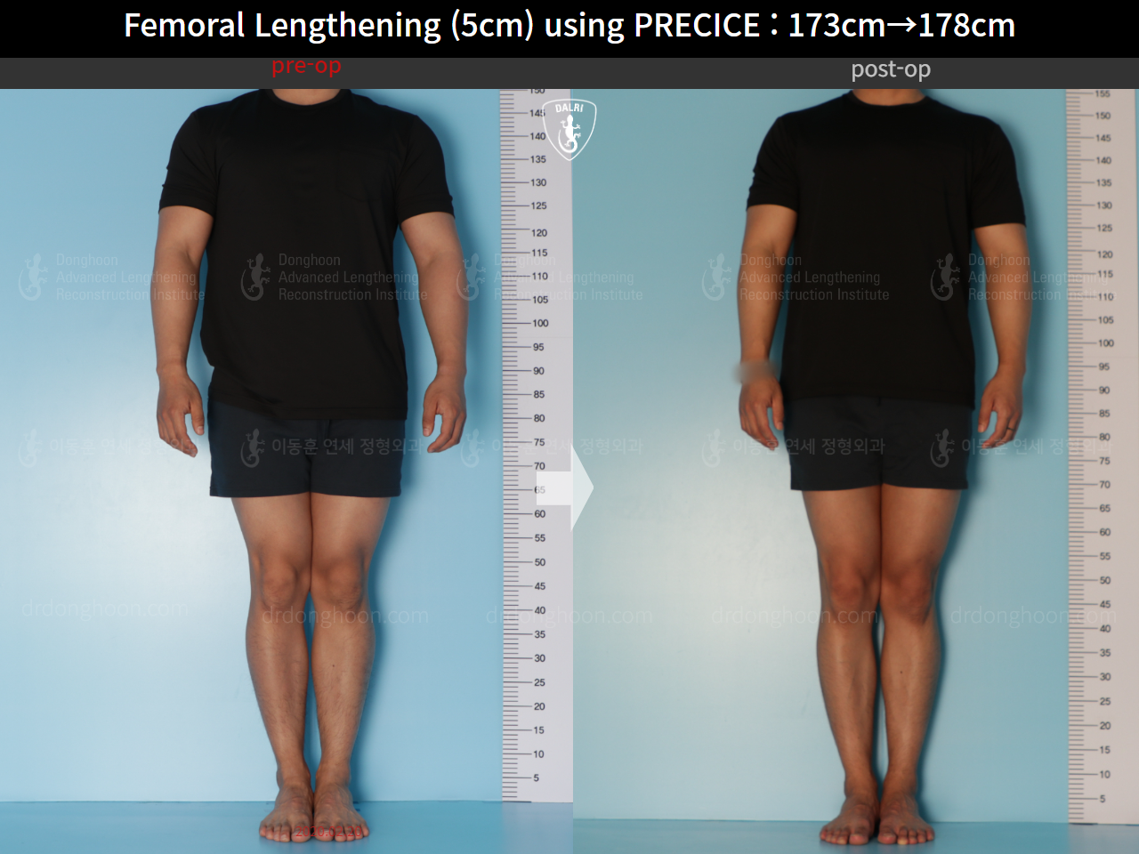 Before and after cll precice, case 21702609, image 3, Dr. Donghoon institute (DALRI)