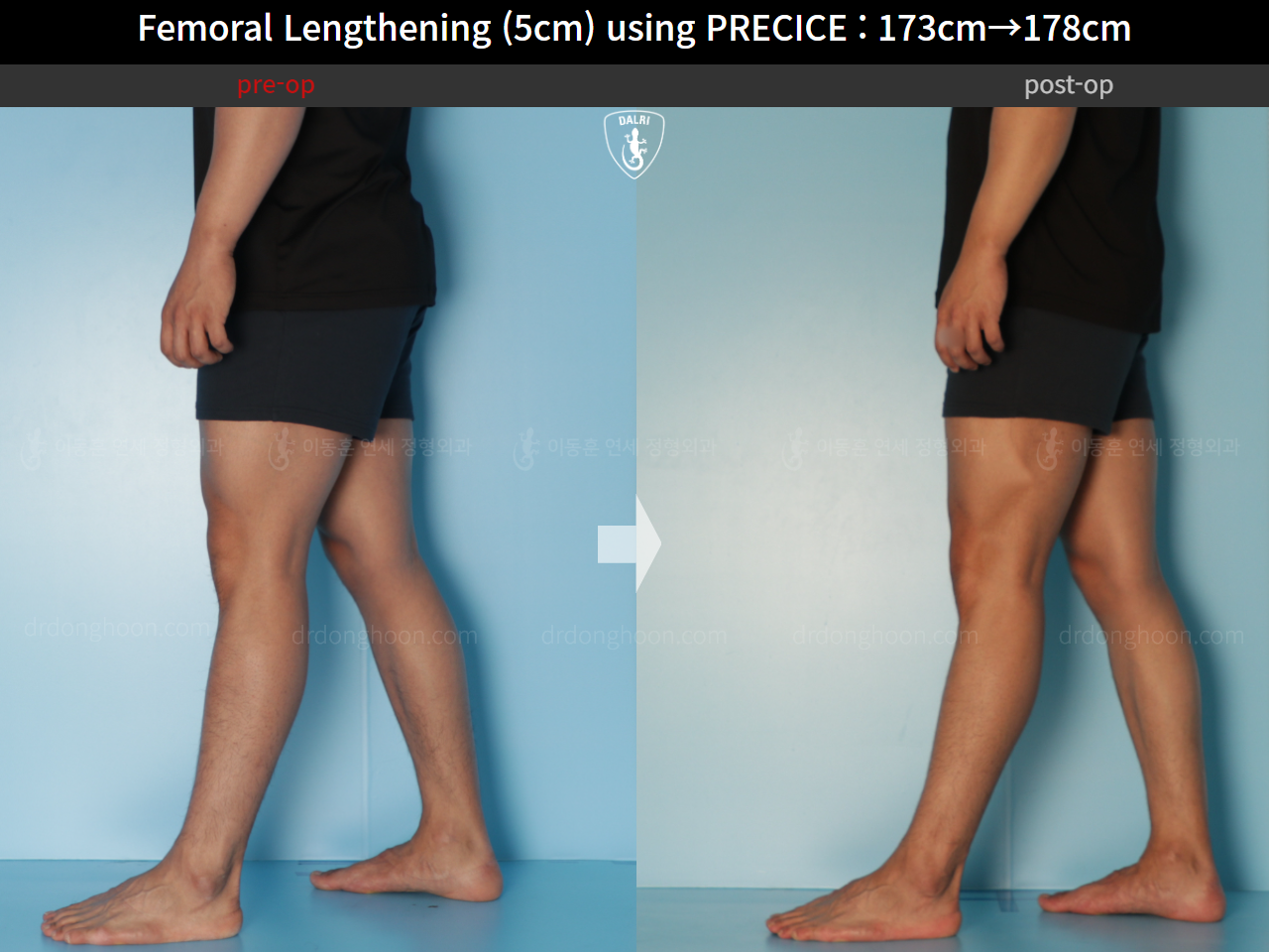 Before and after cll precice, case 21702609, image 10, Dr. Donghoon institute (DALRI)