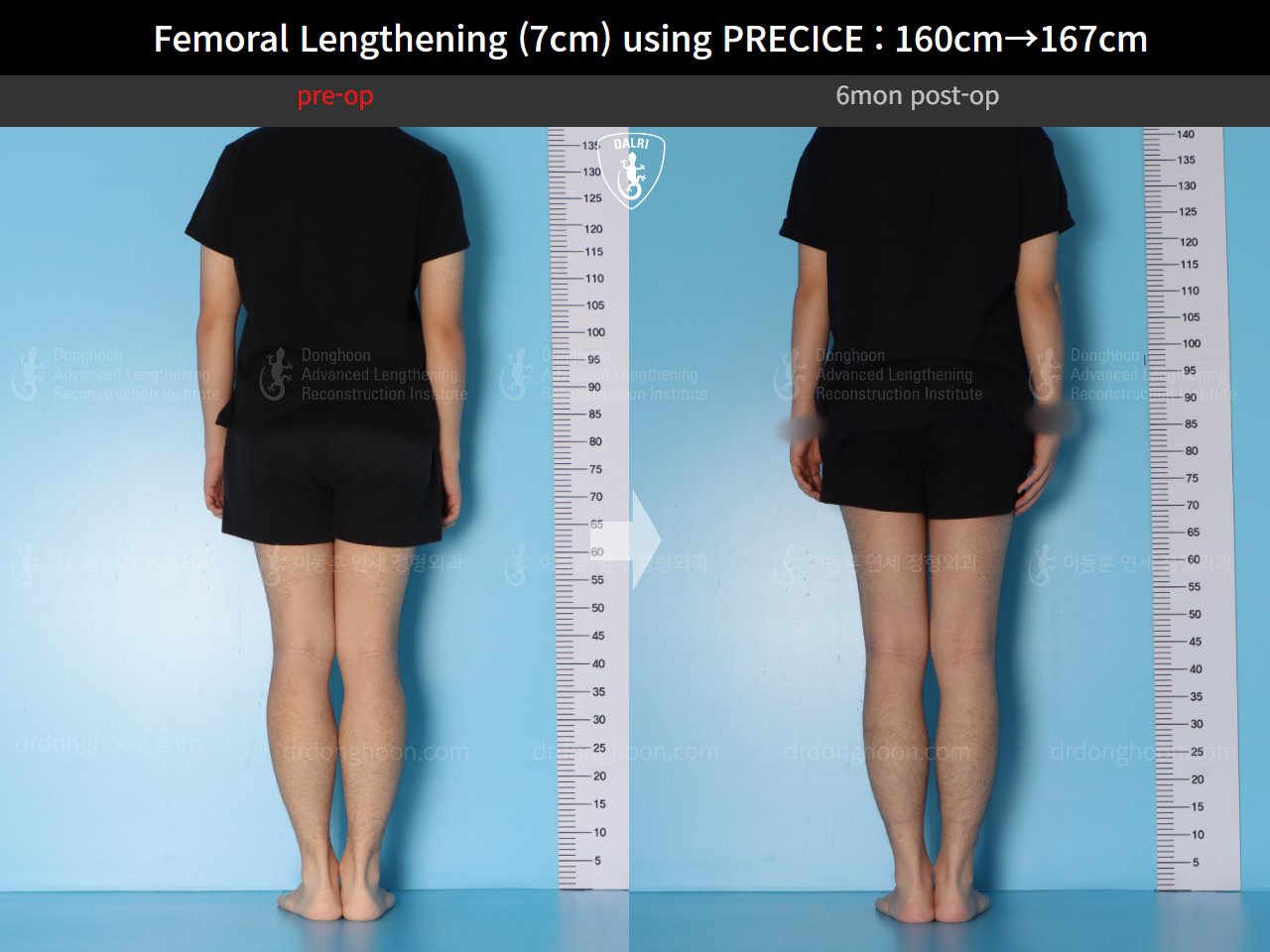 Before and after cll precice, case 15460533, image 3, Dr. Donghoon institute (DALRI)