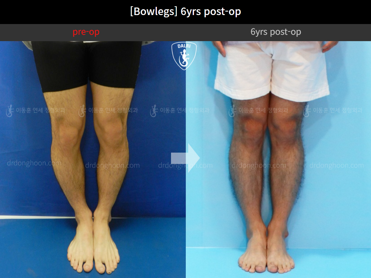 Before and after adult bowlegs, case 11742539, image 3, Dr. Donghoon institute (DALRI)