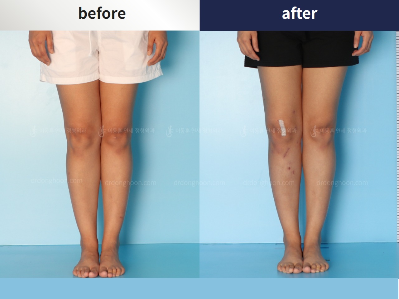 Before and after adult knock knees, case 4310881, image 5, Dr. Donghoon institute (DALRI)