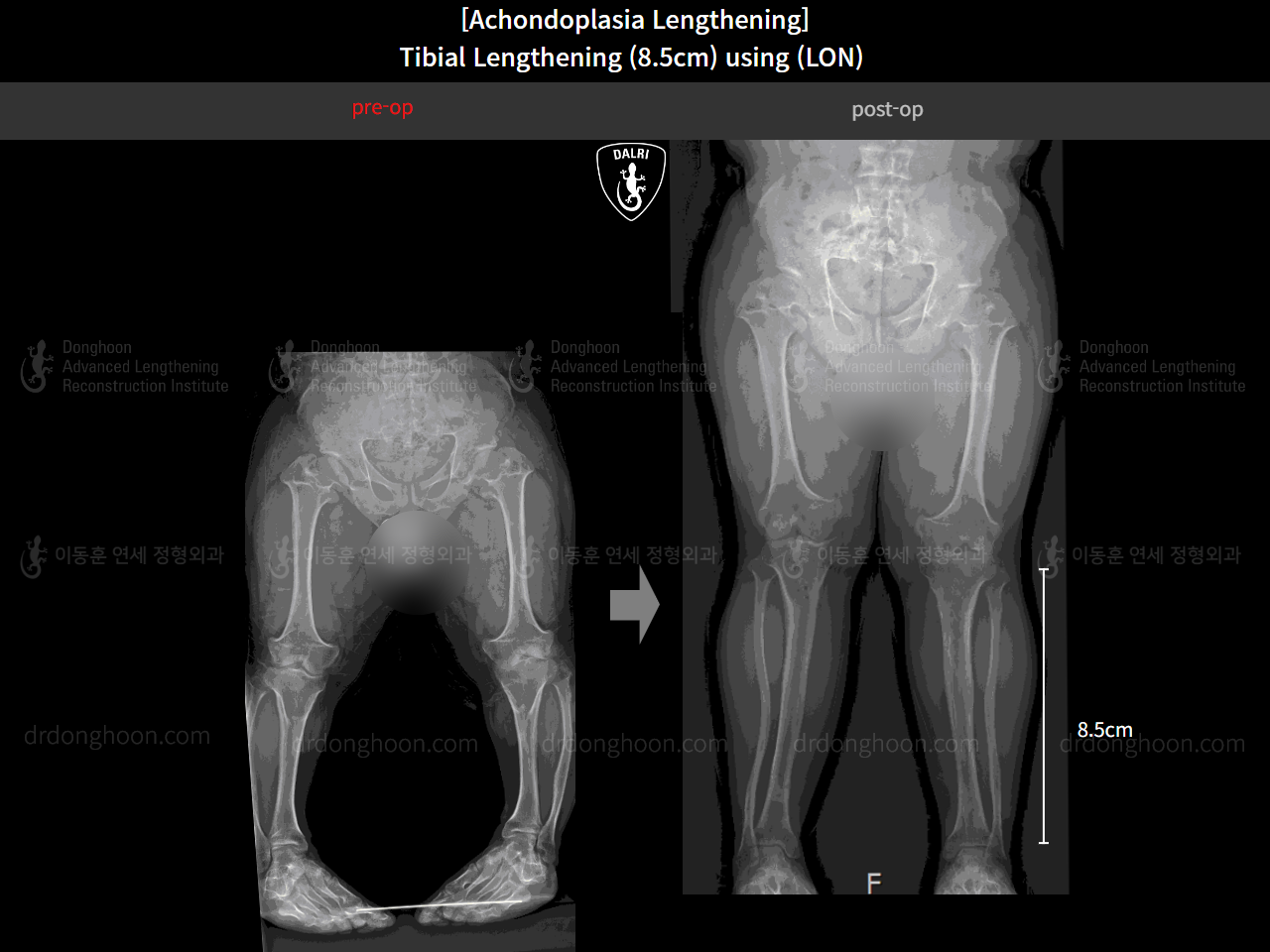 Before and after congenital condition, case 14993507, image 13, Dr. Donghoon institute (DALRI)