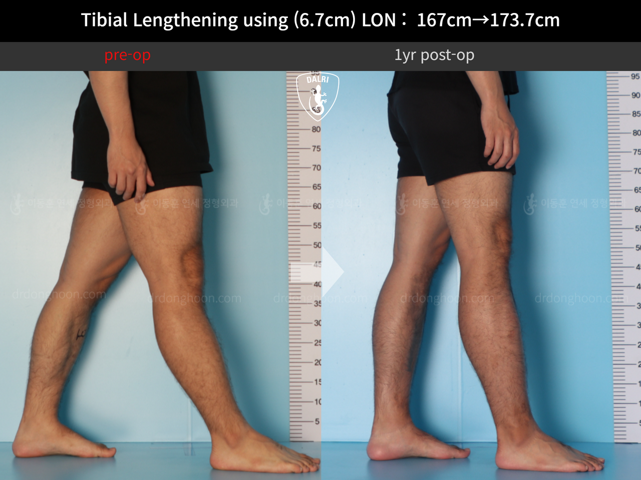 Before and after cll lon, case 12426969, image 7, Dr. Donghoon institute (DALRI)