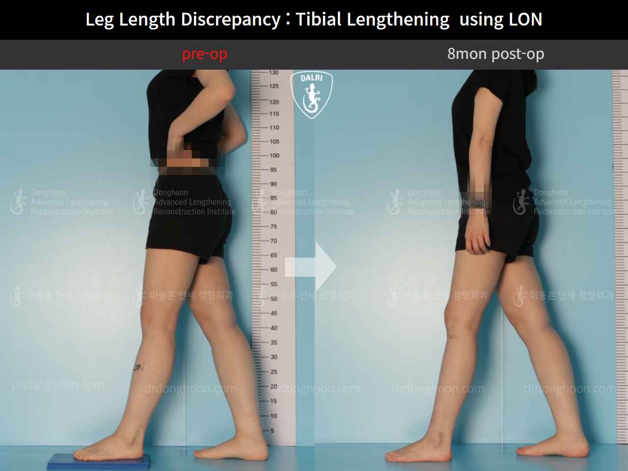 Before and after adult lld, case 10477860, image 3, Dr. Donghoon institute (DALRI)