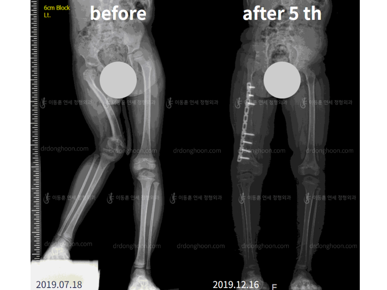 Before and after paediatric & adolescent lld, case 4577152, image 6, Dr. Donghoon institute (DALRI)